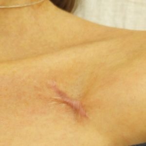 terapia-jazvy-1